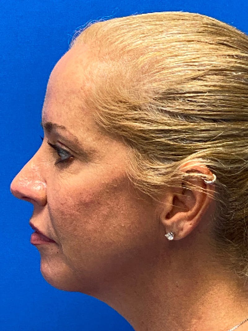 Facelift Before & After Gallery - Patient 298776 - Image 5