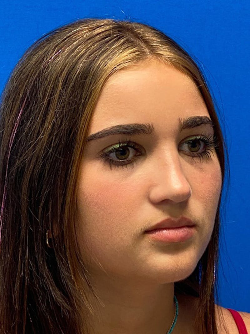 Primary Rhinoplasty Before & After Gallery - Patient 401318 - Image 6