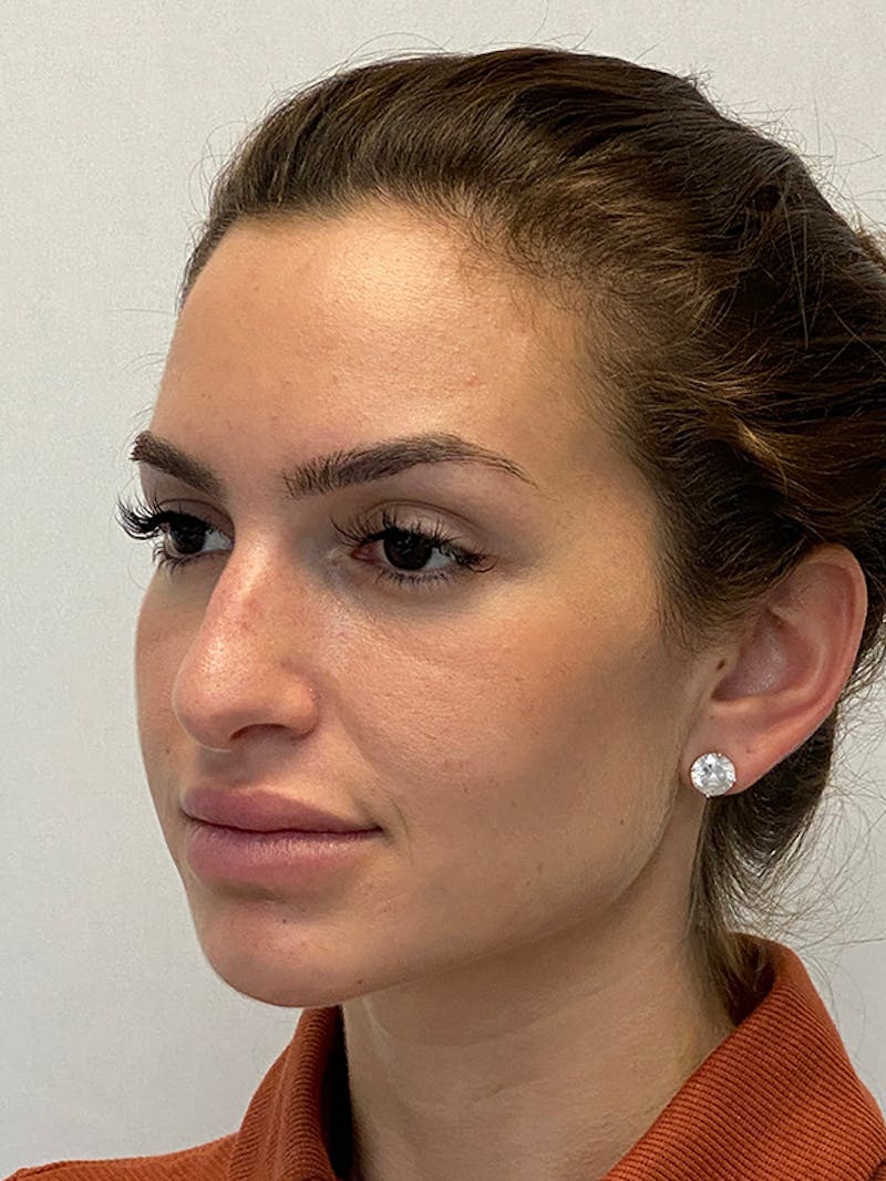 Primary Rhinoplasty Before & After Gallery - Patient 148645 - Image 5
