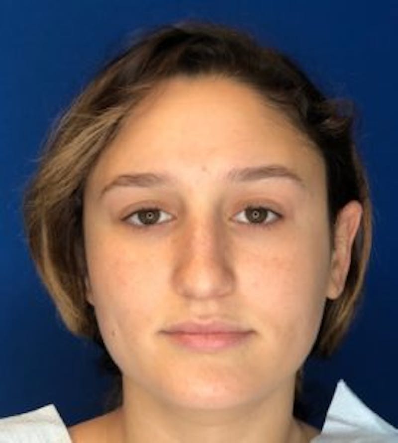 Primary Rhinoplasty Before & After Gallery - Patient 320169 - Image 5
