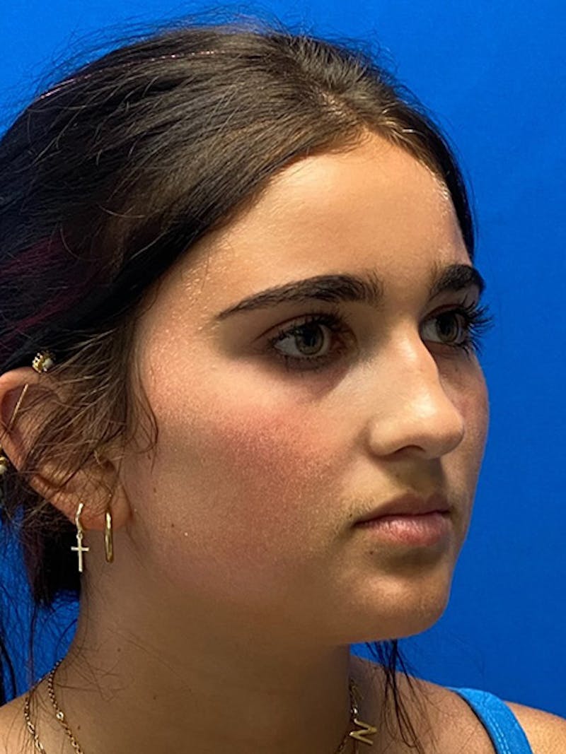 Primary Rhinoplasty Before & After Gallery - Patient 401318 - Image 5