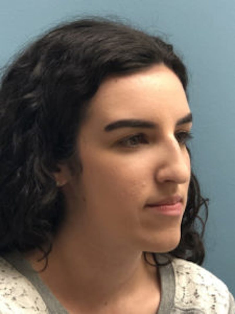 Primary Rhinoplasty Before & After Gallery - Patient 173090 - Image 9