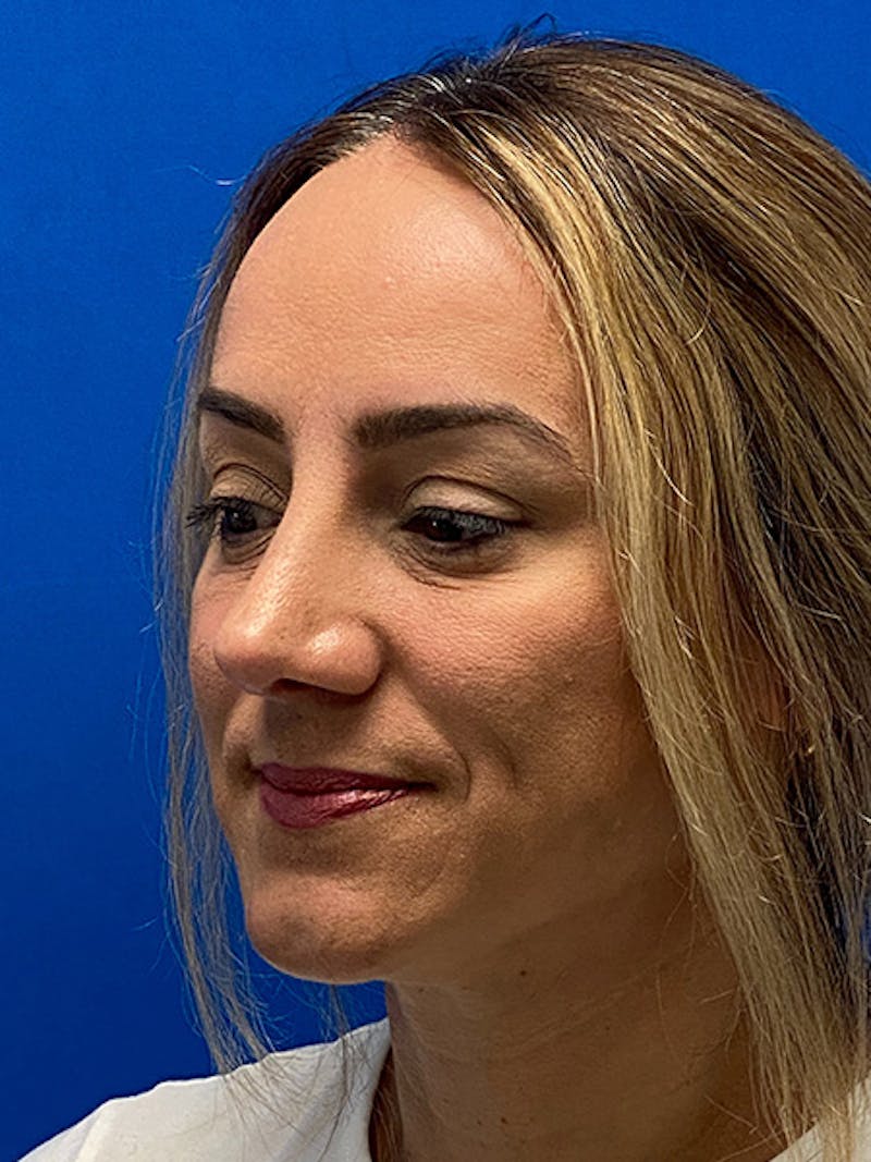 Primary Rhinoplasty Before & After Gallery - Patient 784658 - Image 8