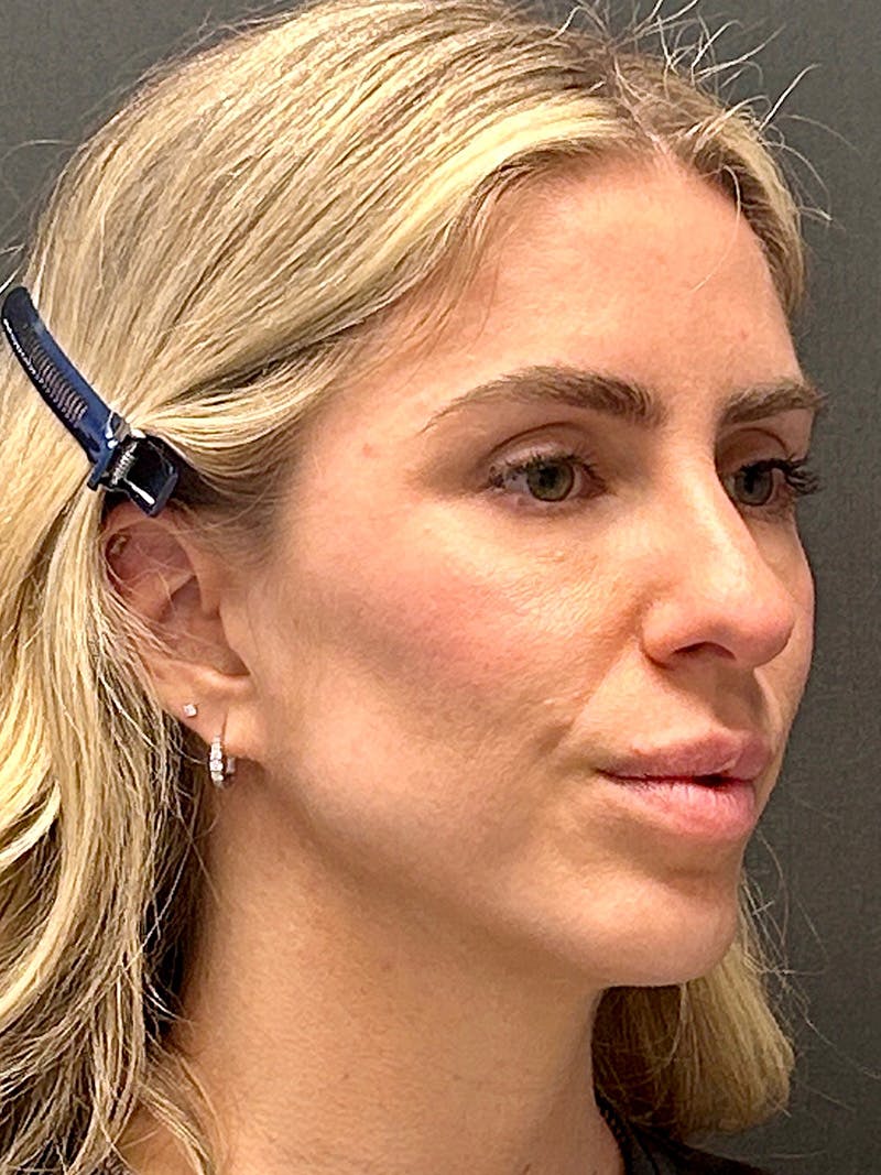 Brow Lift  Before & After Gallery - Patient 260378 - Image 3