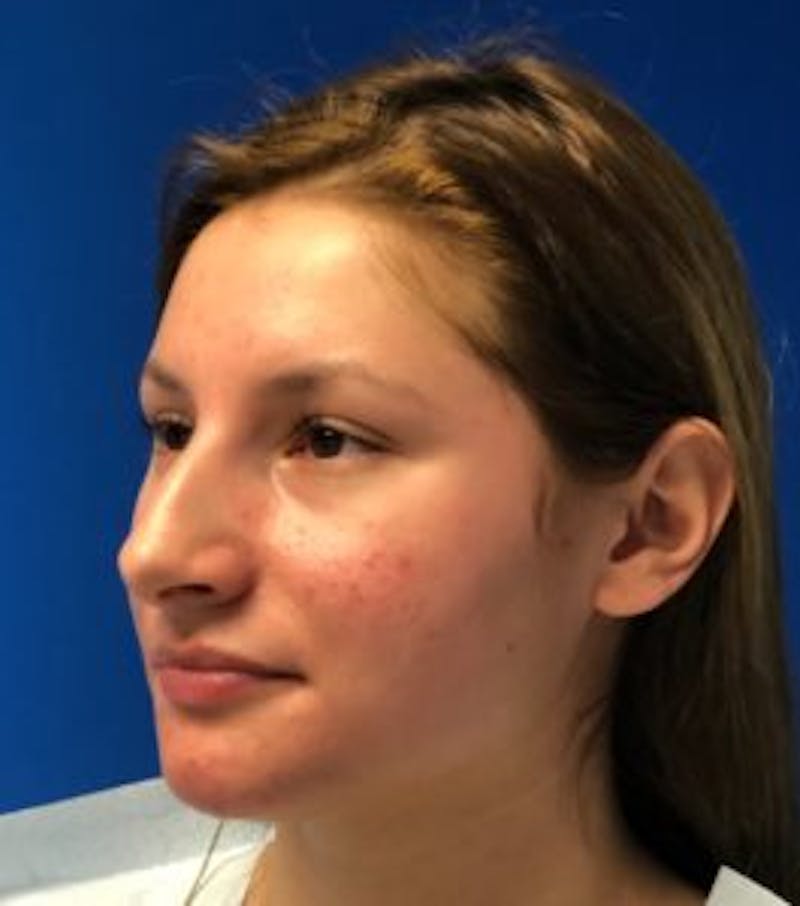 Primary Rhinoplasty Before & After Gallery - Patient 550195 - Image 15
