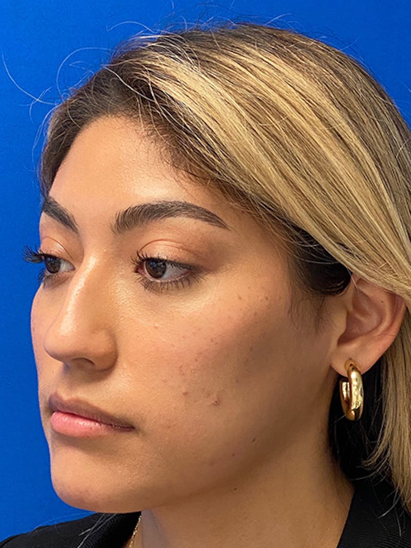 Primary Rhinoplasty Before & After Gallery - Patient 317021 - Image 5