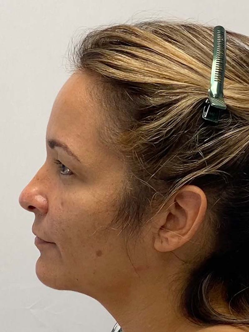Facelift Before & After Gallery - Patient 181295 - Image 9