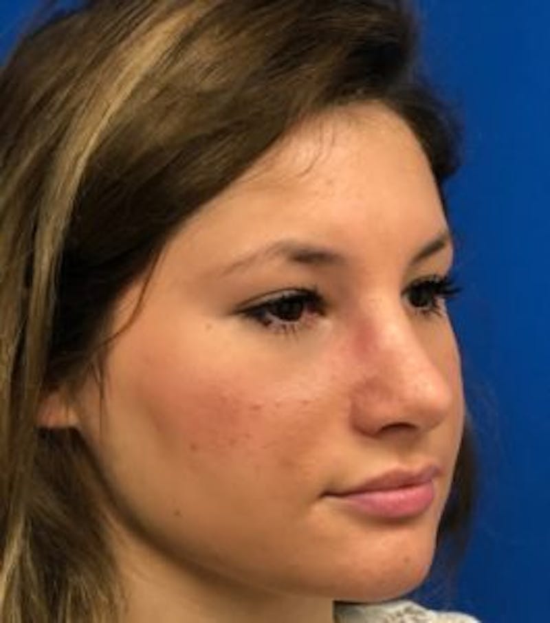 Primary Rhinoplasty Before & After Gallery - Patient 550195 - Image 8