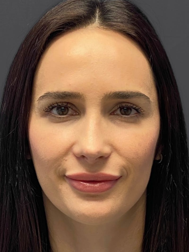 Revision Rhinoplasty Before & After Gallery - Patient 240059 - Image 4