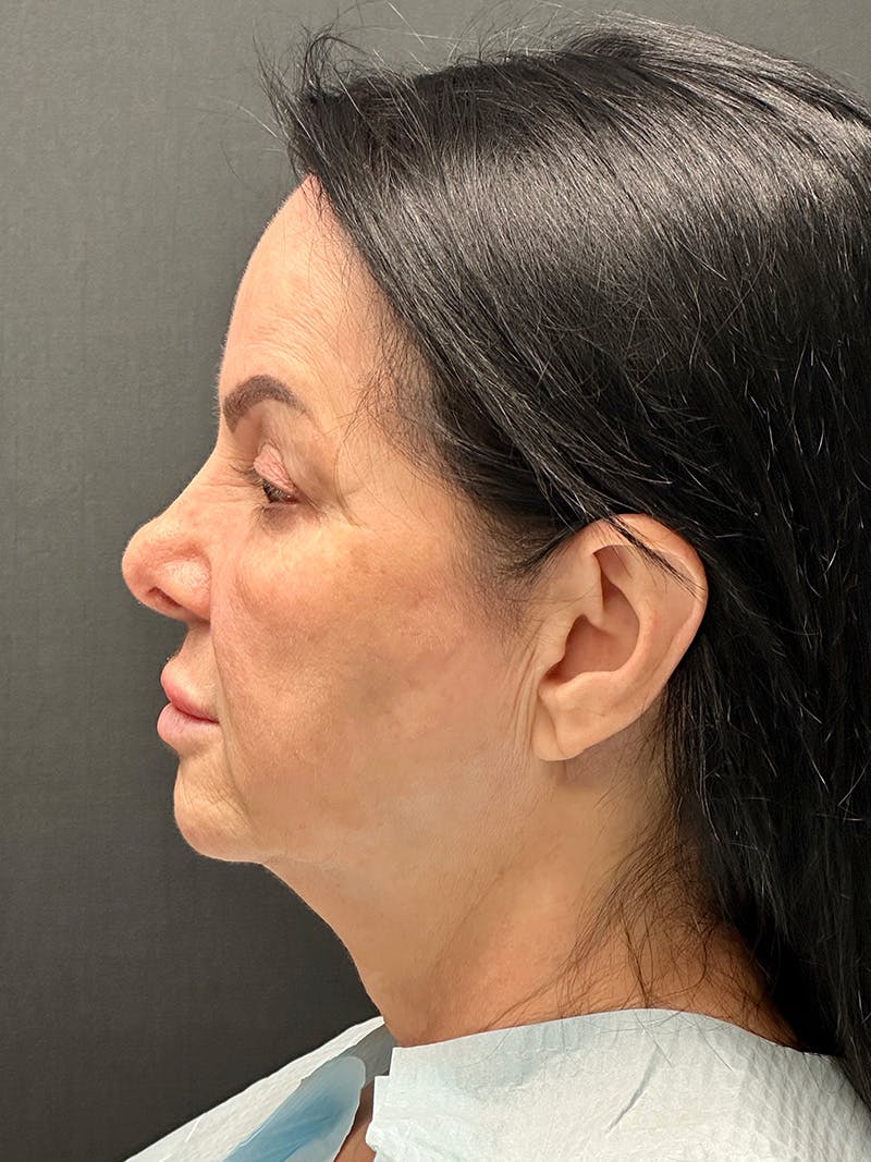 Blepharoplasty Before & After Gallery - Patient 409475 - Image 5