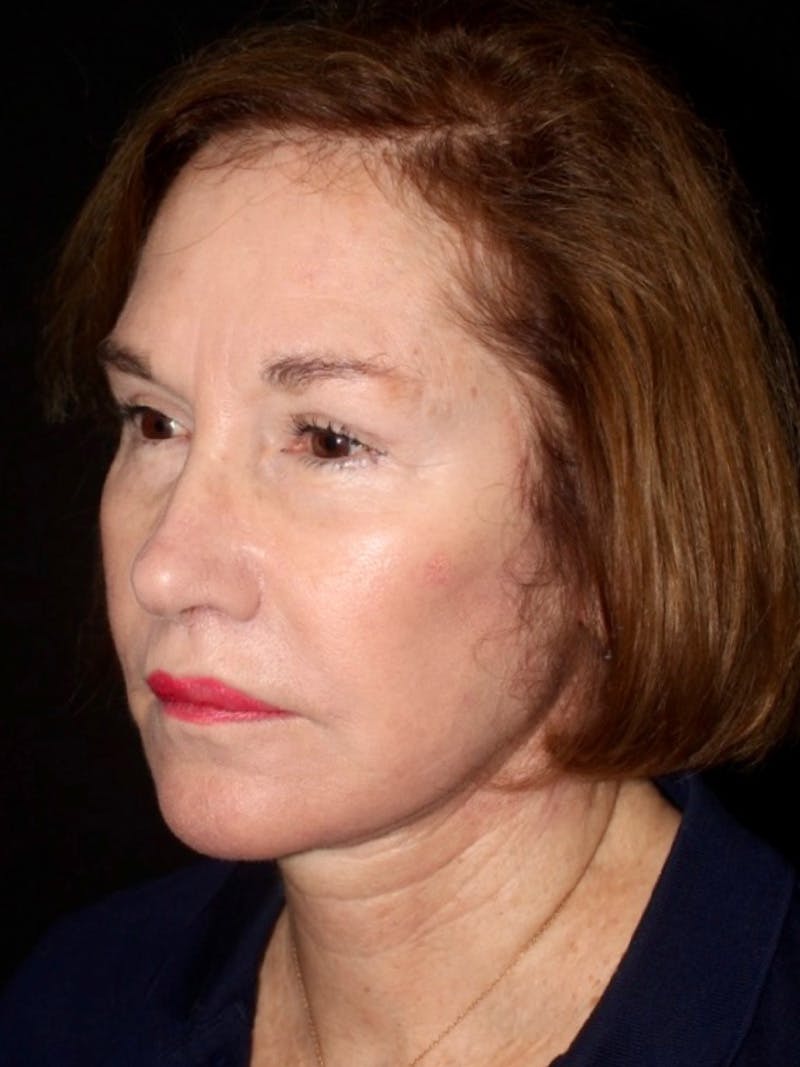 Facelift Before & After Gallery - Patient 349569 - Image 4