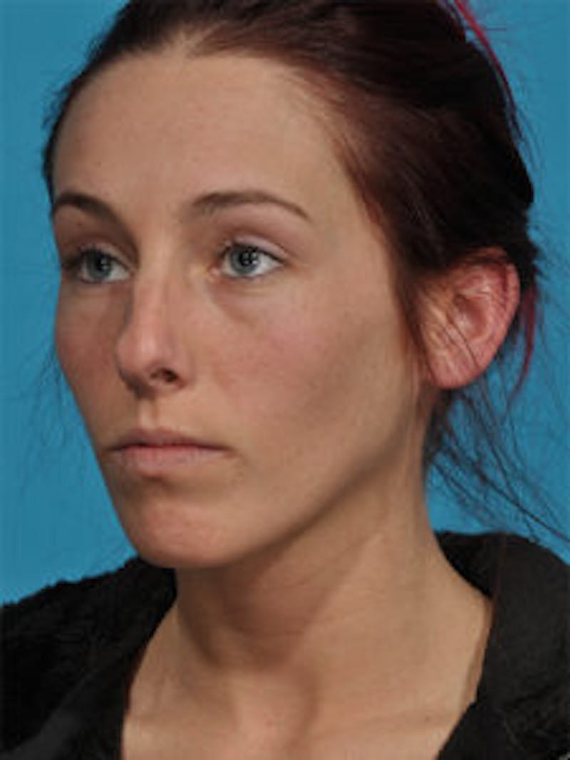Primary Rhinoplasty Before & After Gallery - Patient 262137 - Image 7