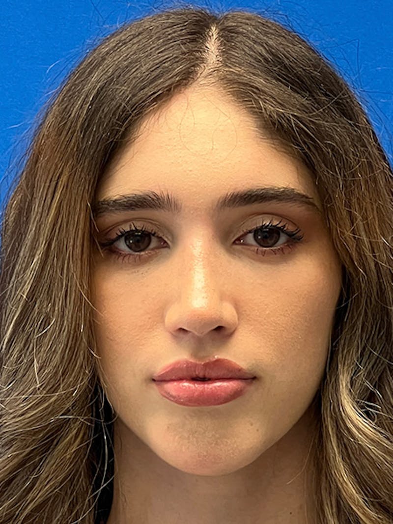 Primary Rhinoplasty Before & After Gallery - Patient 342098 - Image 4