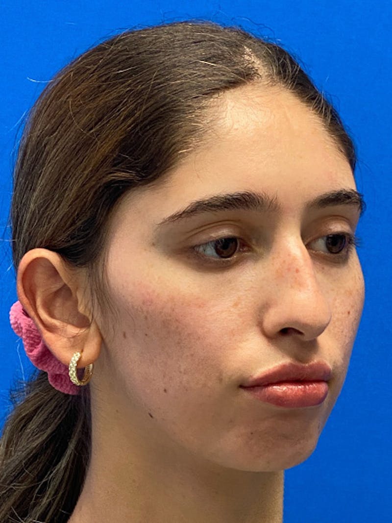 Primary Rhinoplasty Before & After Gallery - Patient 342098 - Image 5