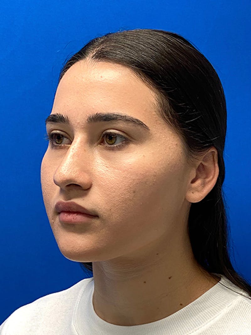 Revision Rhinoplasty Before & After Gallery - Patient 597867 - Image 5