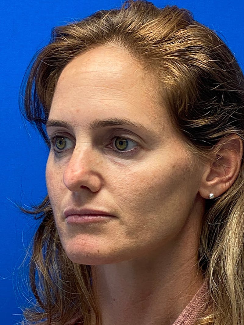 Revision Rhinoplasty Before & After Gallery - Patient 330413 - Image 5