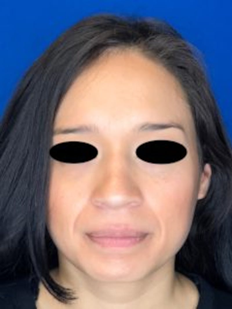 Primary Rhinoplasty Before & After Gallery - Patient 879608 - Image 3