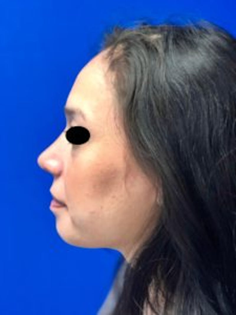 Primary Rhinoplasty Before & After Gallery - Patient 879608 - Image 6