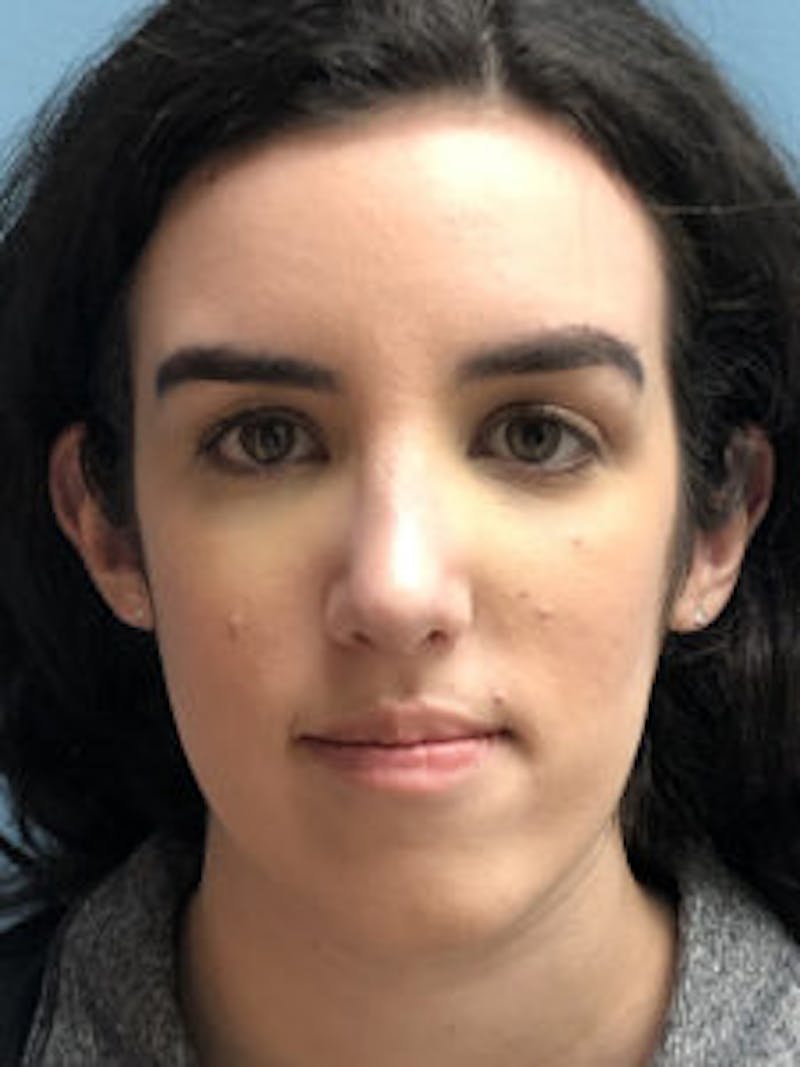 Primary Rhinoplasty Before & After Gallery - Patient 173090 - Image 4