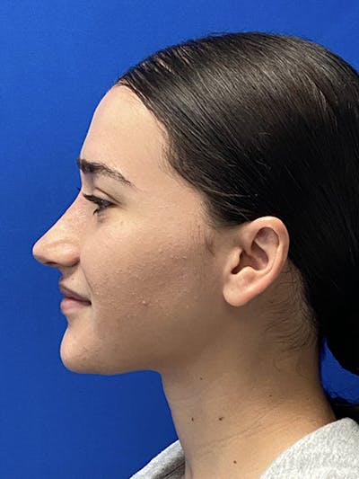 Revision Rhinoplasty Before & After Gallery - Patient 597867 - Image 2