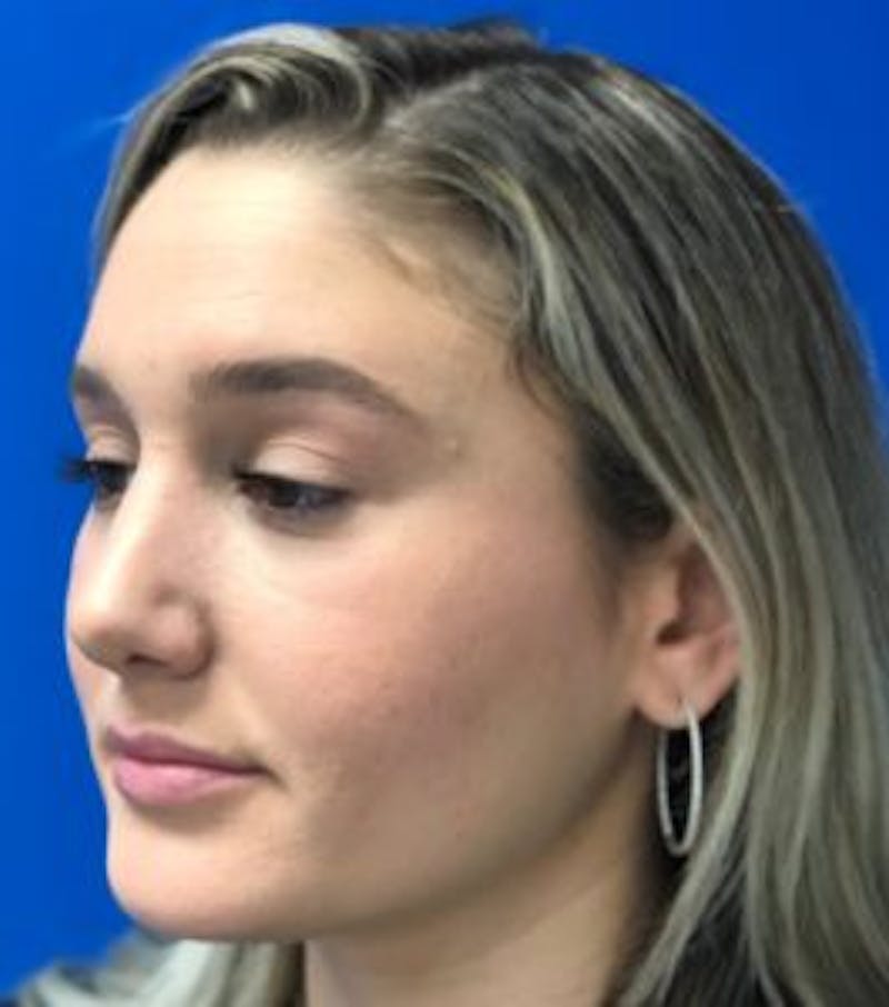 Primary Rhinoplasty Before & After Gallery - Patient 320169 - Image 16