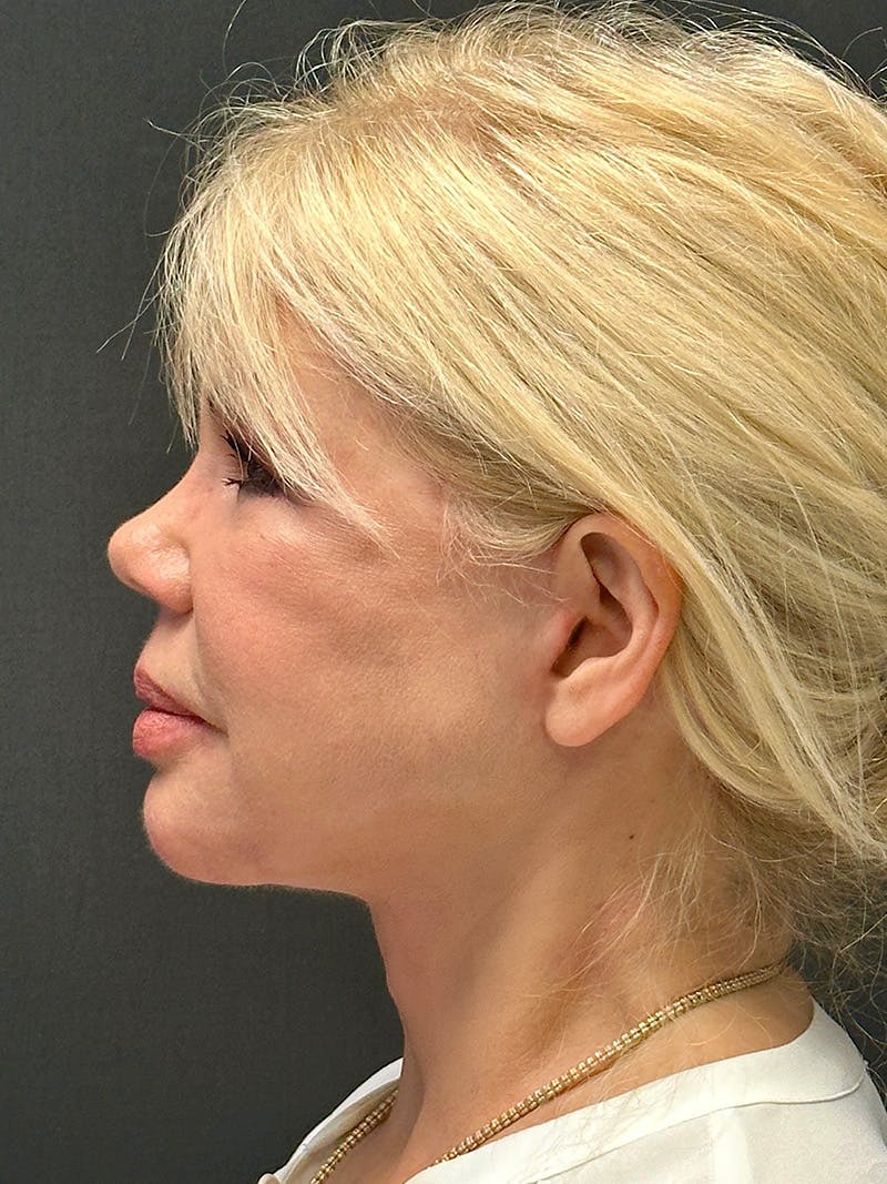 Facelift Before & After Gallery - Patient 112257 - Image 6
