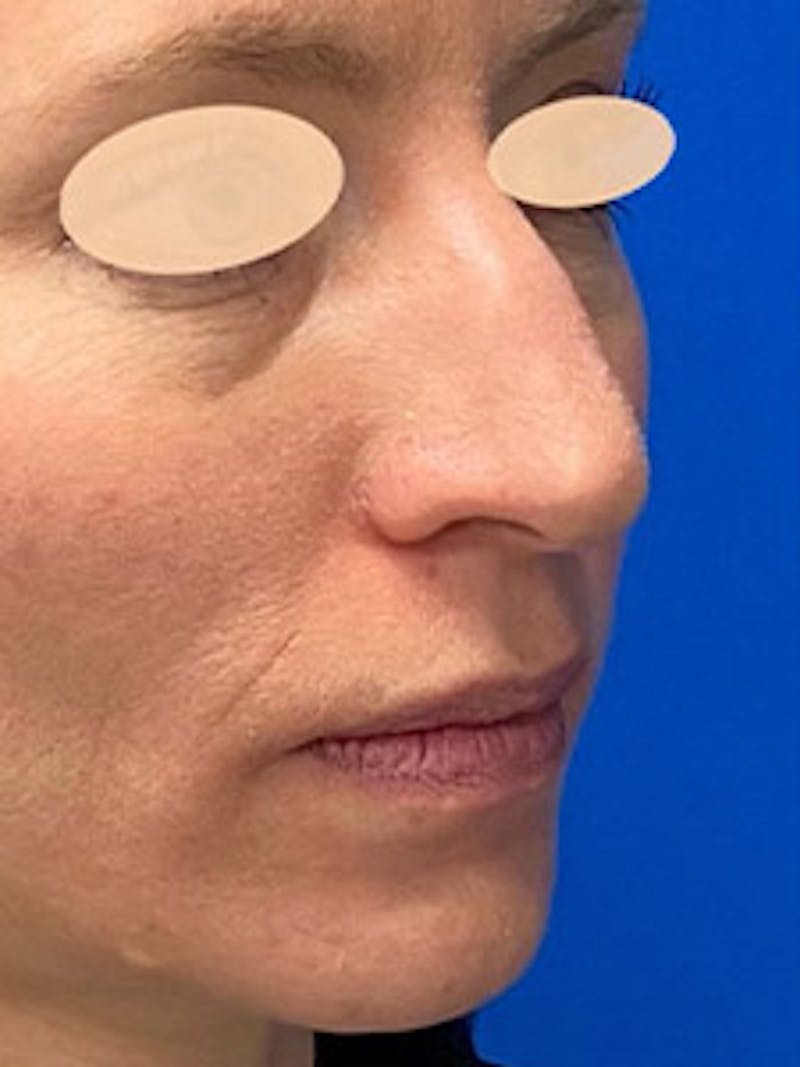 Primary Rhinoplasty Before & After Gallery - Patient 305892 - Image 7