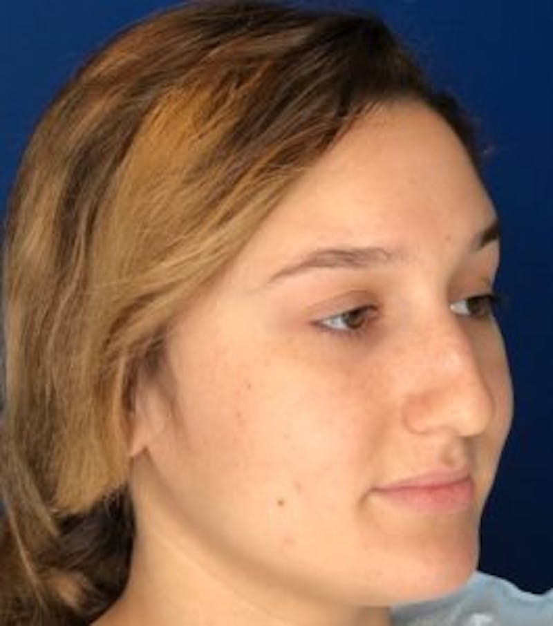 Primary Rhinoplasty Before & After Gallery - Patient 320169 - Image 7