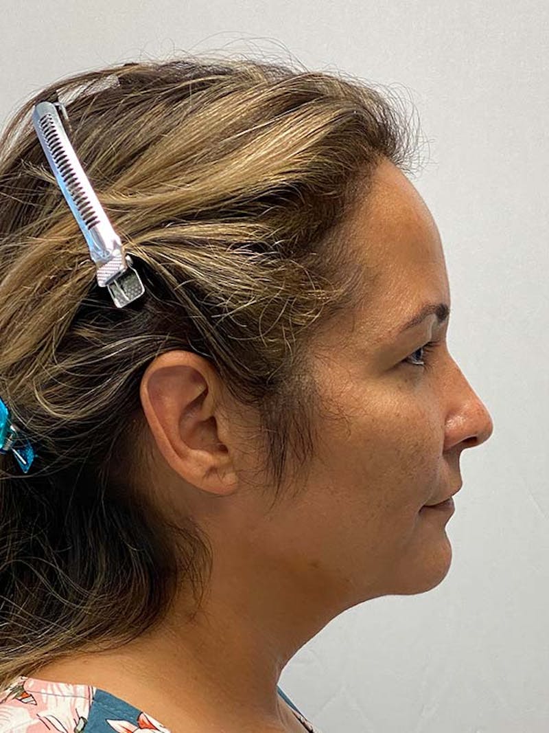 Facelift Before & After Gallery - Patient 181295 - Image 5