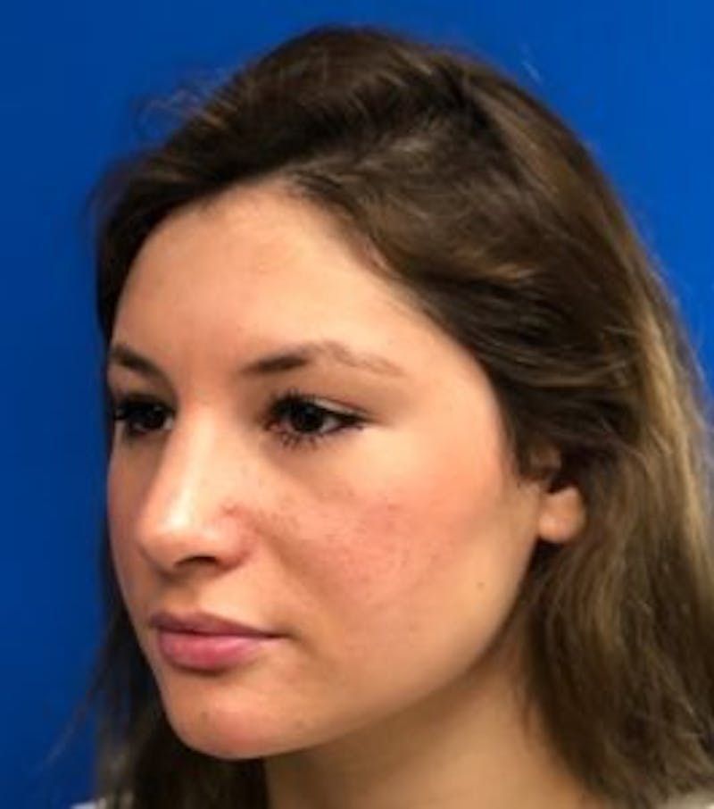 Primary Rhinoplasty Before & After Gallery - Patient 550195 - Image 16