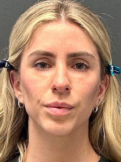 Brow Lift Before & After Gallery - Patient 386431 - Image 1