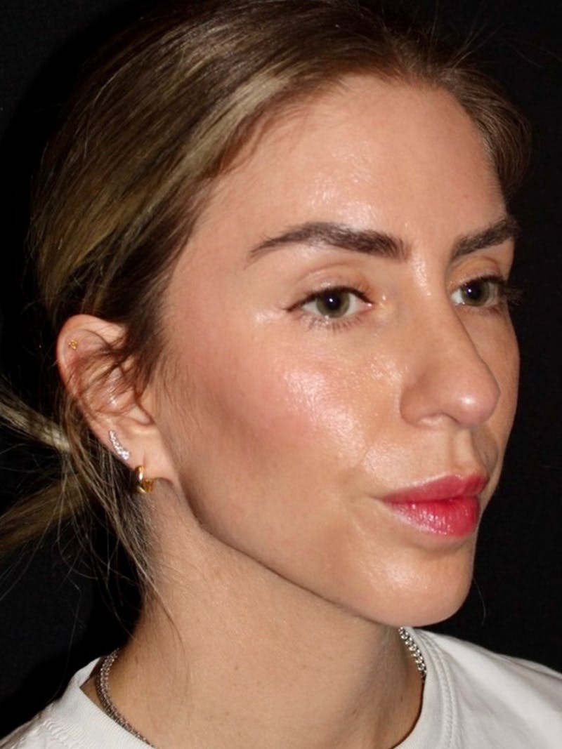 Brow Lift  Before & After Gallery - Patient 260378 - Image 4
