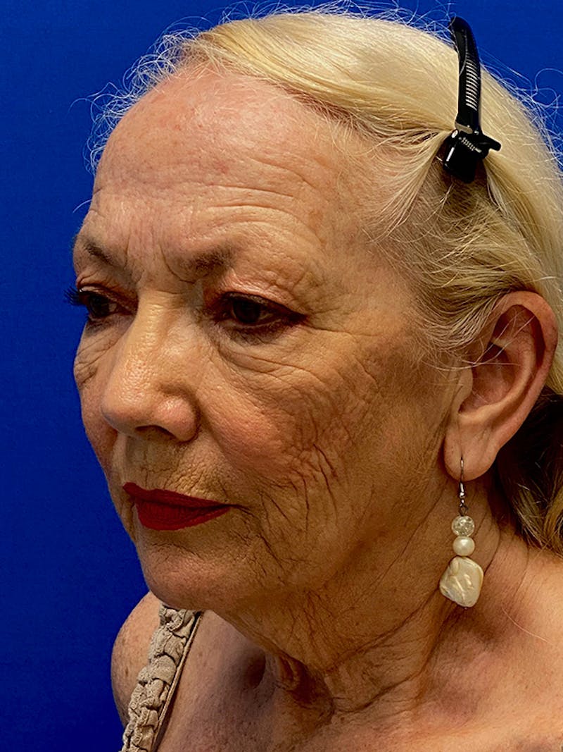 Facelift Before & After Gallery - Patient 326906 - Image 3