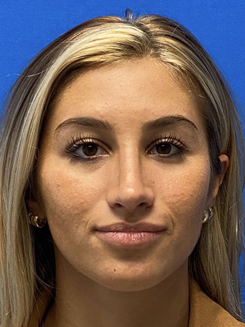 Primary Rhinoplasty Before & After Gallery - Patient 328366 - Image 4