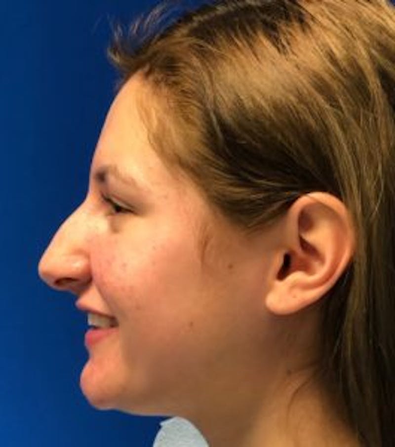 Primary Rhinoplasty Before & After Gallery - Patient 550195 - Image 13