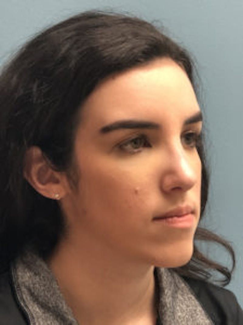 Primary Rhinoplasty Before & After Gallery - Patient 173090 - Image 10