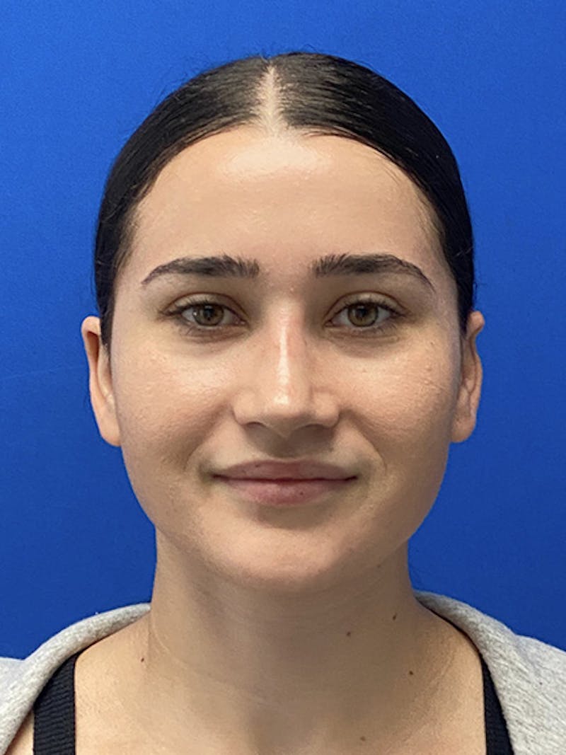 Revision Rhinoplasty Before & After Gallery - Patient 597867 - Image 4