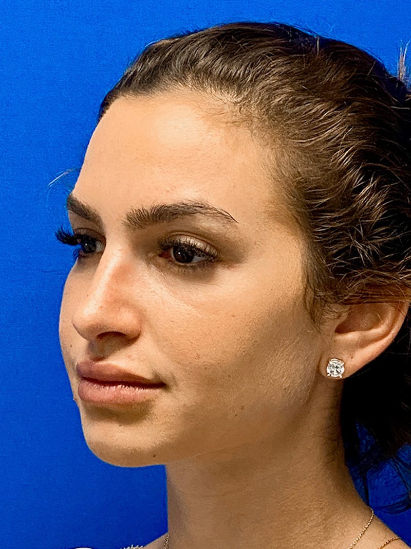 Primary Rhinoplasty Before & After Gallery - Patient 148645 - Image 6