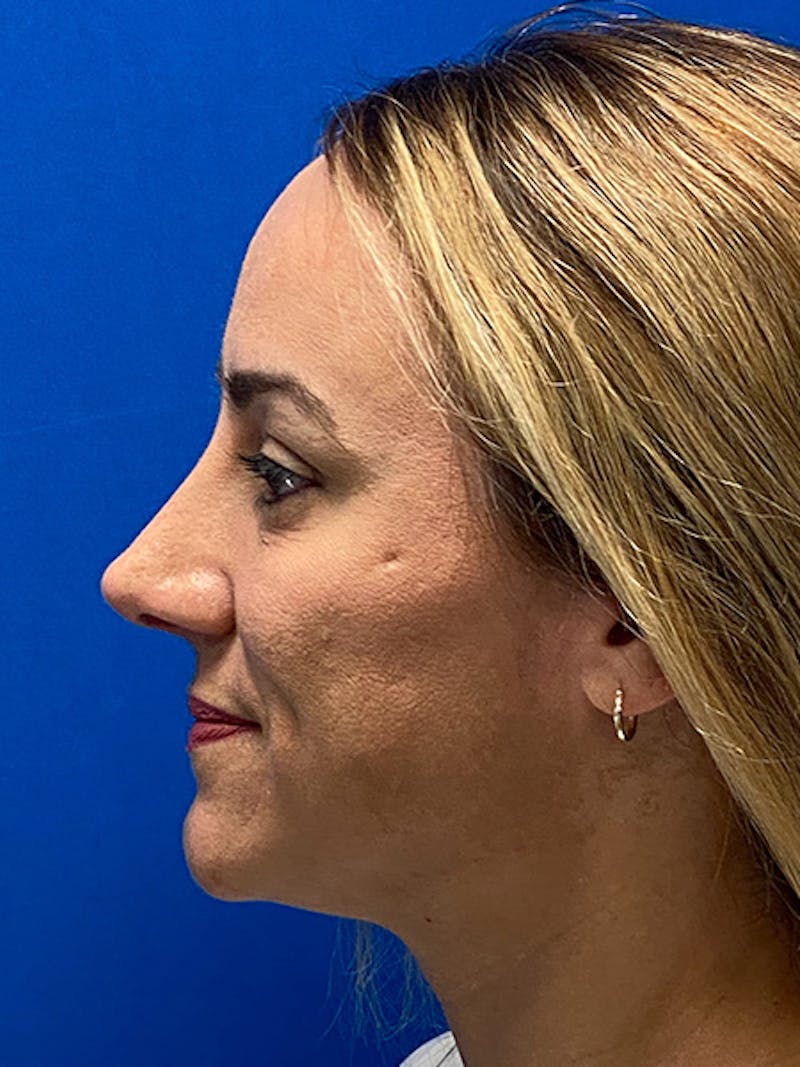 Primary Rhinoplasty Before & After Gallery - Patient 784658 - Image 6