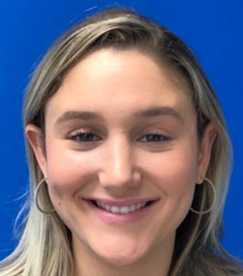 Primary Rhinoplasty Before & After Gallery - Patient 320169 - Image 4