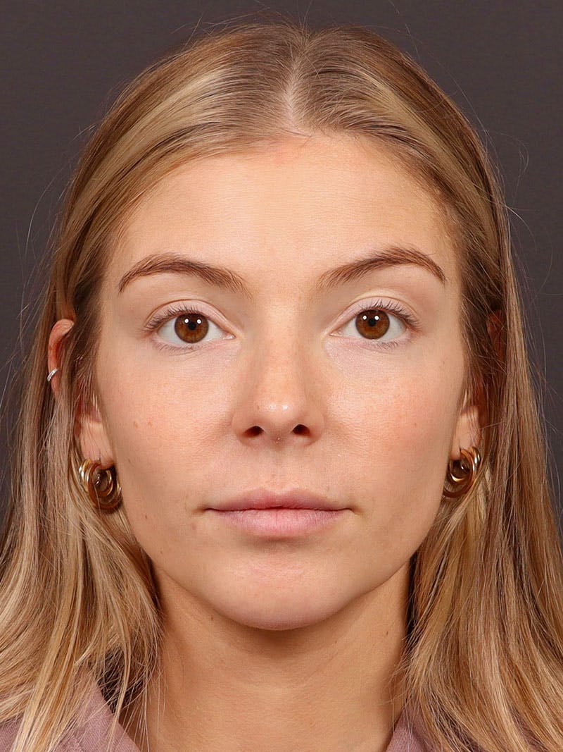 Primary Rhinoplasty Before & After Gallery - Patient 194014 - Image 4