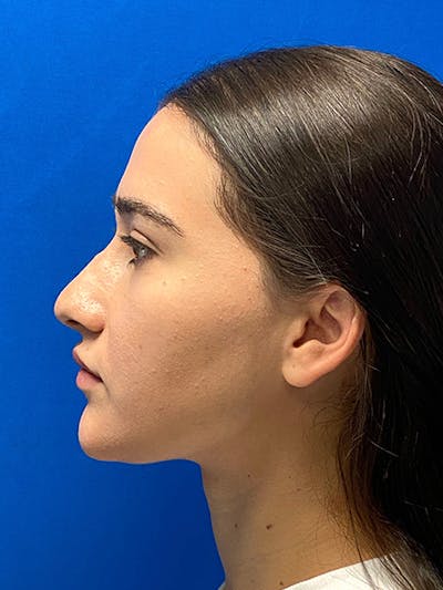 Revision Rhinoplasty Before & After Gallery - Patient 597867 - Image 1