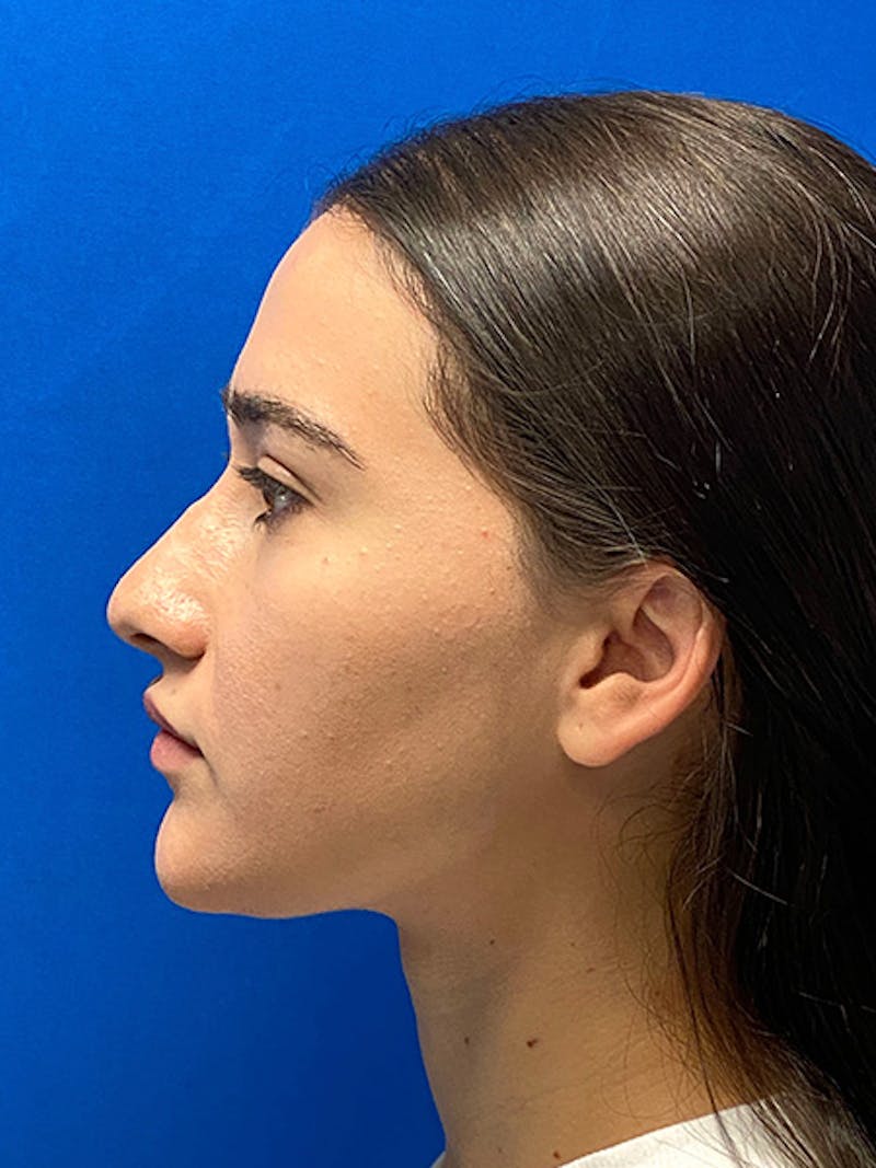 Revision Rhinoplasty Before & After Gallery - Patient 597867 - Image 1