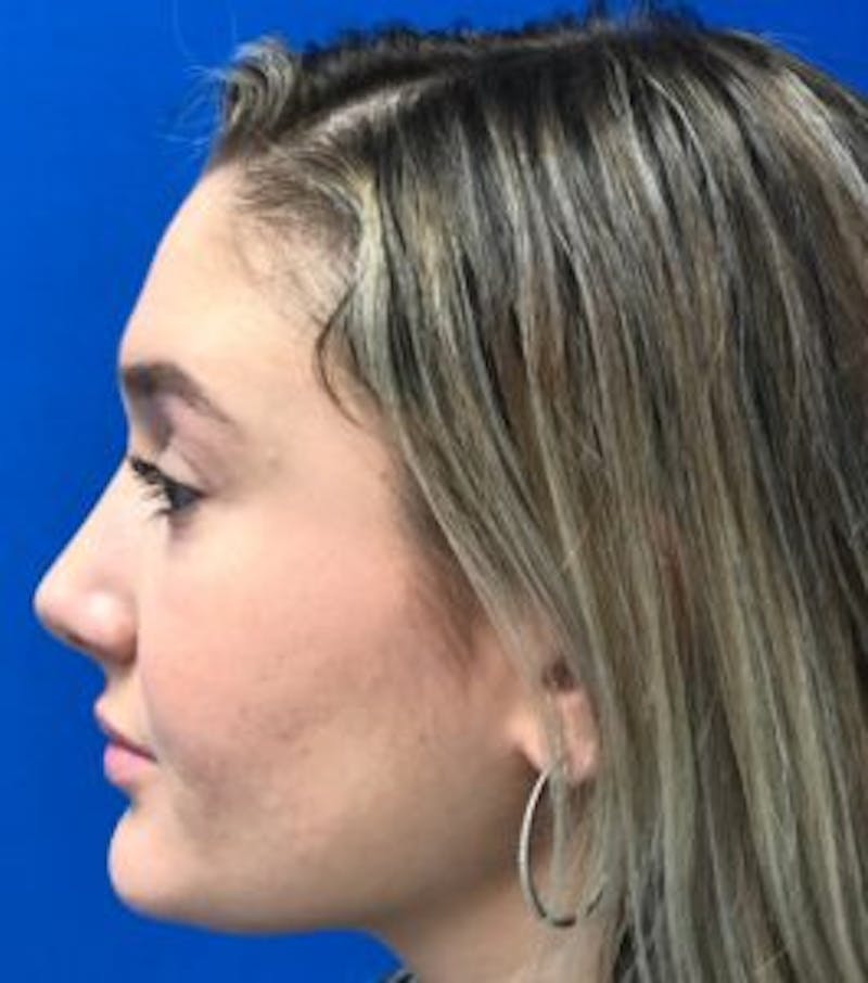 Primary Rhinoplasty Before & After Gallery - Patient 320169 - Image 14