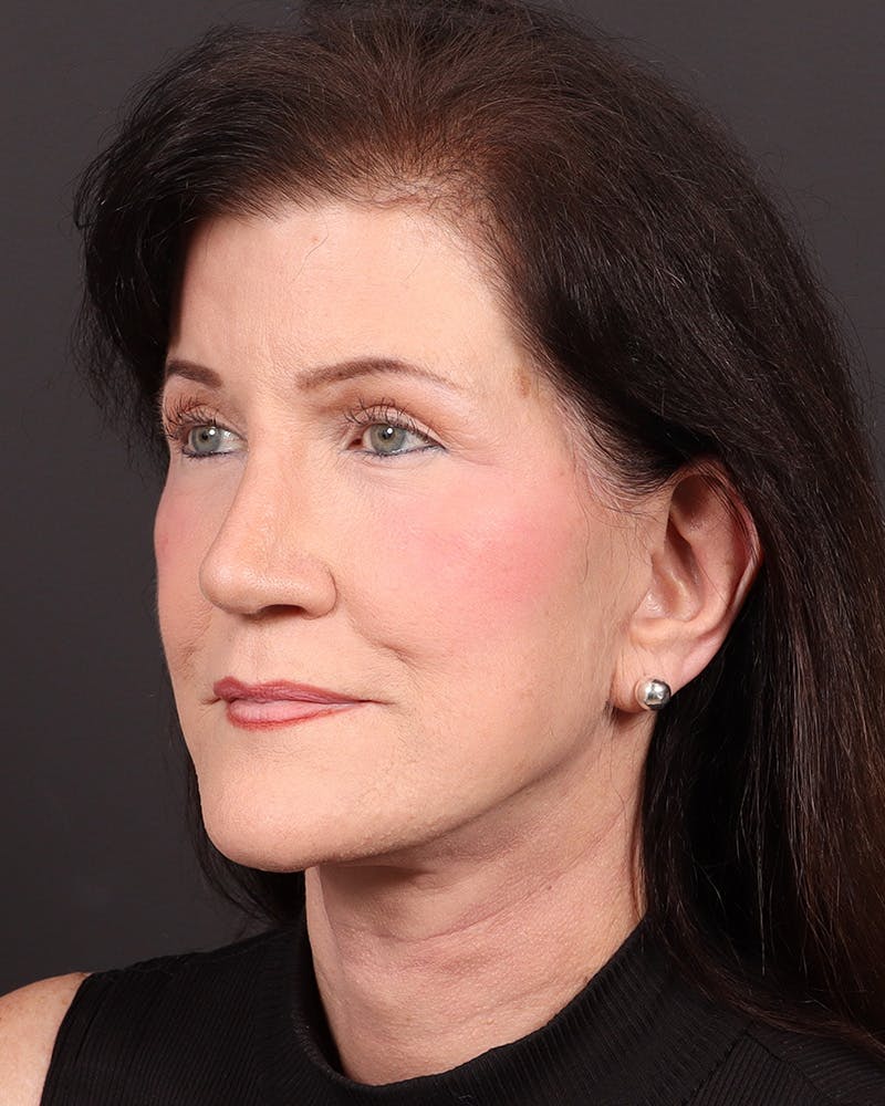 Facelift Before & After Gallery - Patient 116970 - Image 4