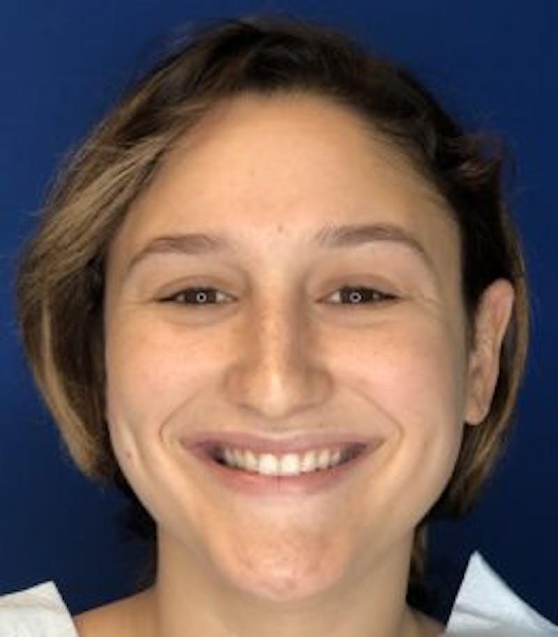 Primary Rhinoplasty Before & After Gallery - Patient 320169 - Image 3