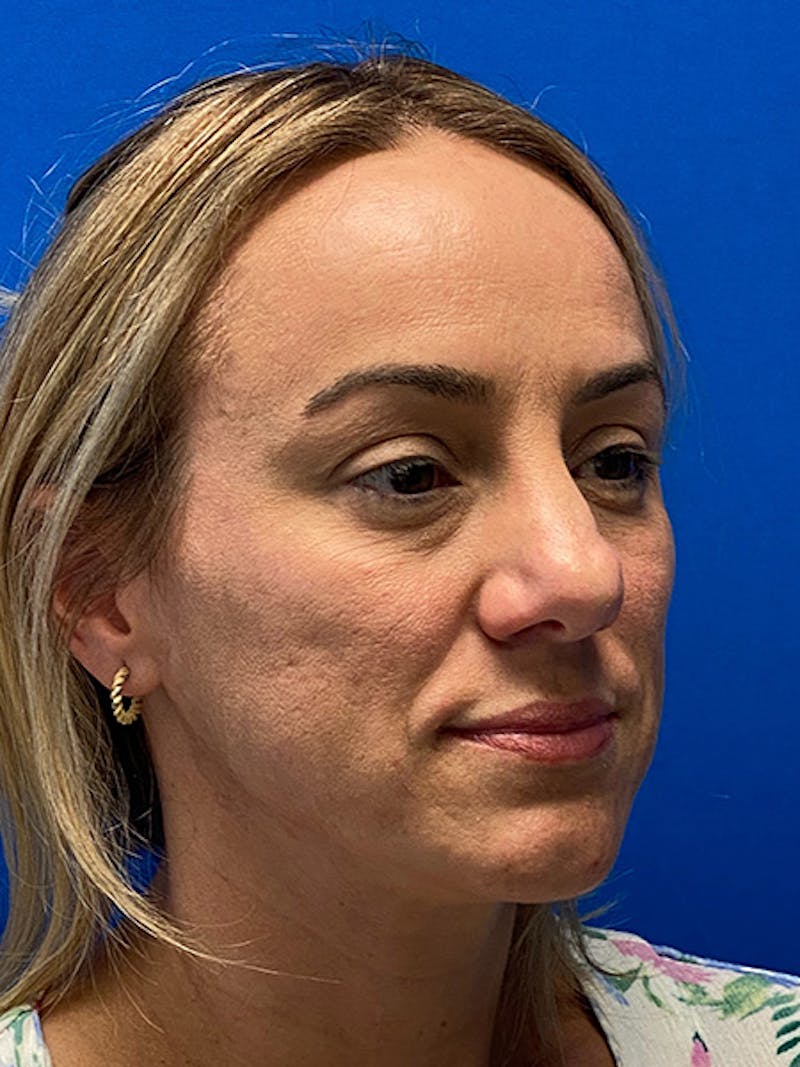 Primary Rhinoplasty Before & After Gallery - Patient 784658 - Image 9