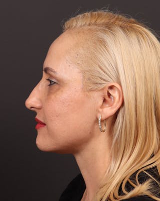 Facelift Before & After Gallery - Patient 104845 - Image 4