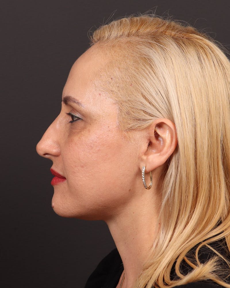 Facelift Before & After Gallery - Patient 104845 - Image 4