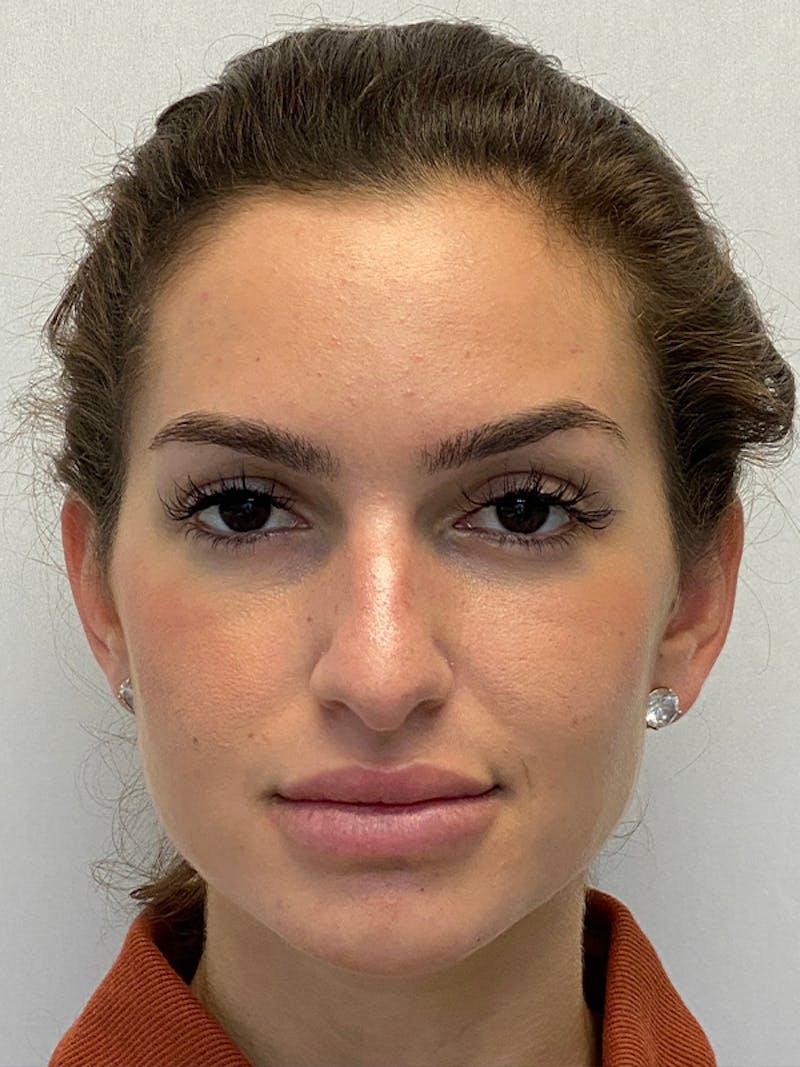 Primary Rhinoplasty Before & After Gallery - Patient 148645 - Image 3